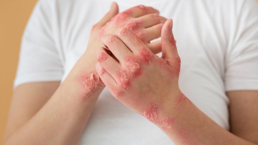 Psoriasis