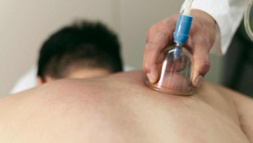 Cupping or Hijama