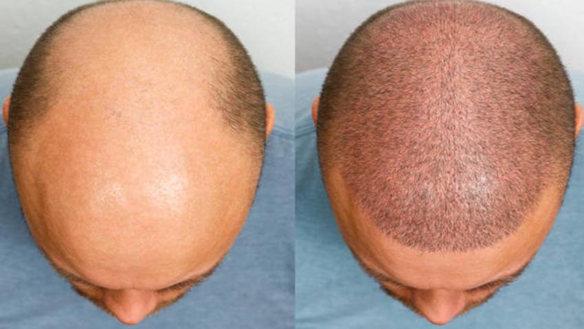 Hair Transplant