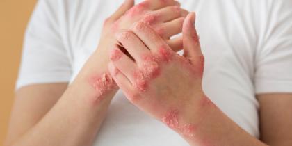 Psoriasis