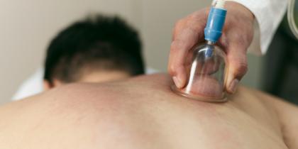 Cupping or Hijama