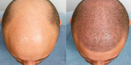 Hair Transplant