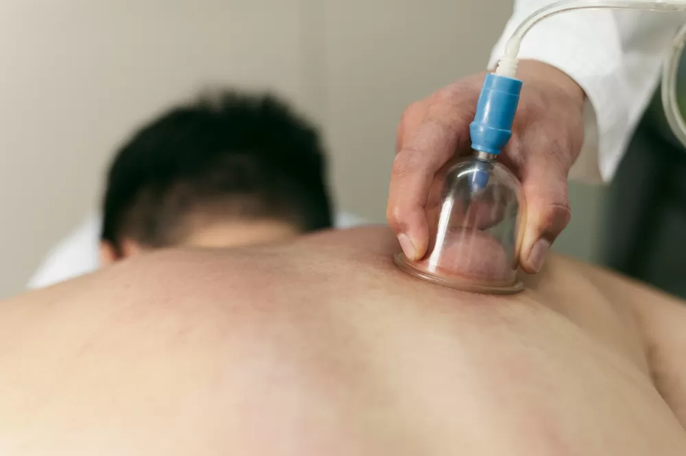 Cupping or Hijama